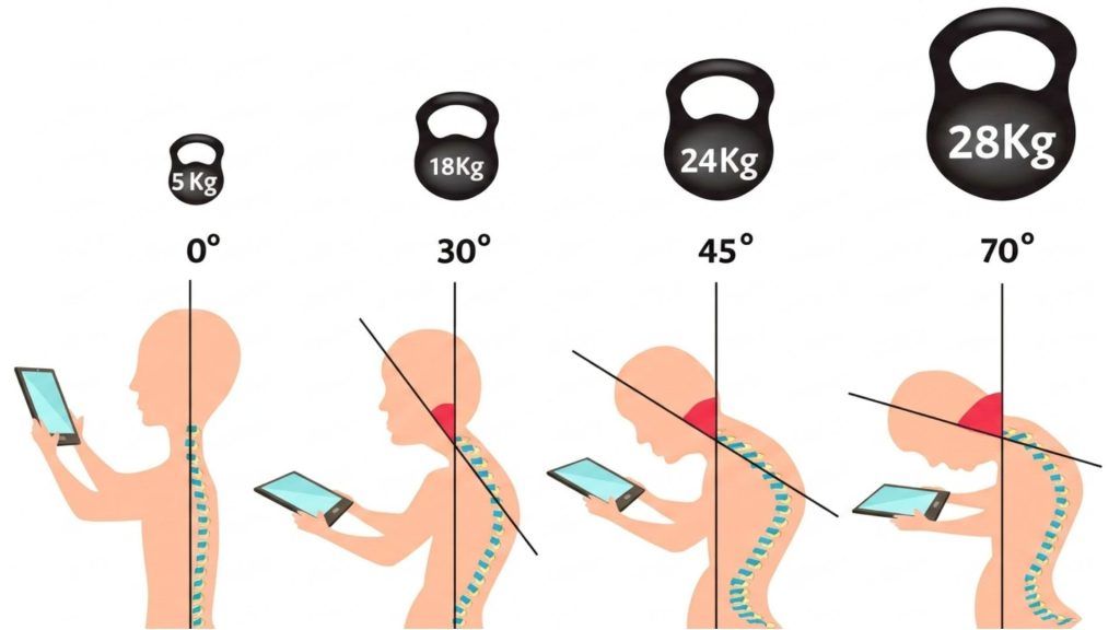 Text Neck, el dolor de cuello más temido por uso del teléfono móvil El text neck se describe como un síndrome de uso excesivo y prolongado del smartphone que causa dolor en cuello y hombros. En la era digital, el uso constante de dispositivos móviles ha llevado al aumento de una afección conocida como "text neck" o síndrome del cuello de texto. Esta condición se caracteriza por dolor y rigidez en el cuello debido a la postura inclinada hacia adelante al mirar el móvil.