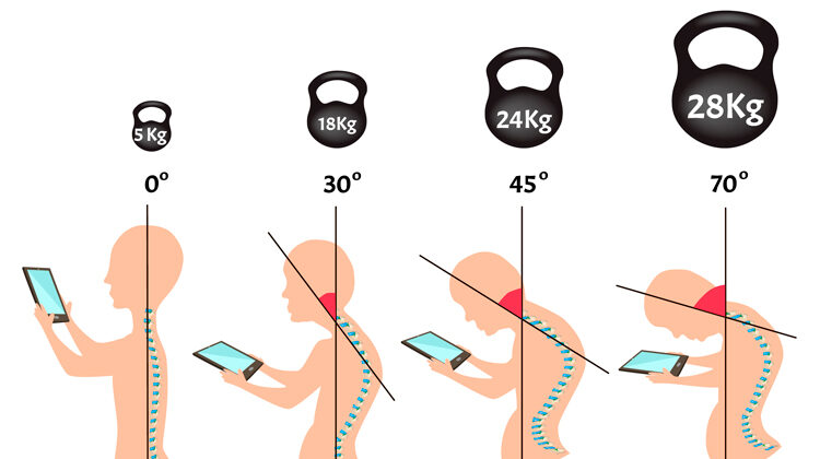 sindrome_cuello_texto_1-750x420