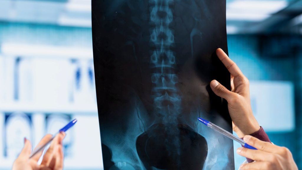 Rehabilitación tras una lesión medular: cómo es el proceso y qué tratamientos ayudan a recuperar la máxima autonomía Rehabilitación tras una lesión medular: cómo es el proceso y qué tratamientos ayudan a recuperar la máxima autonomía